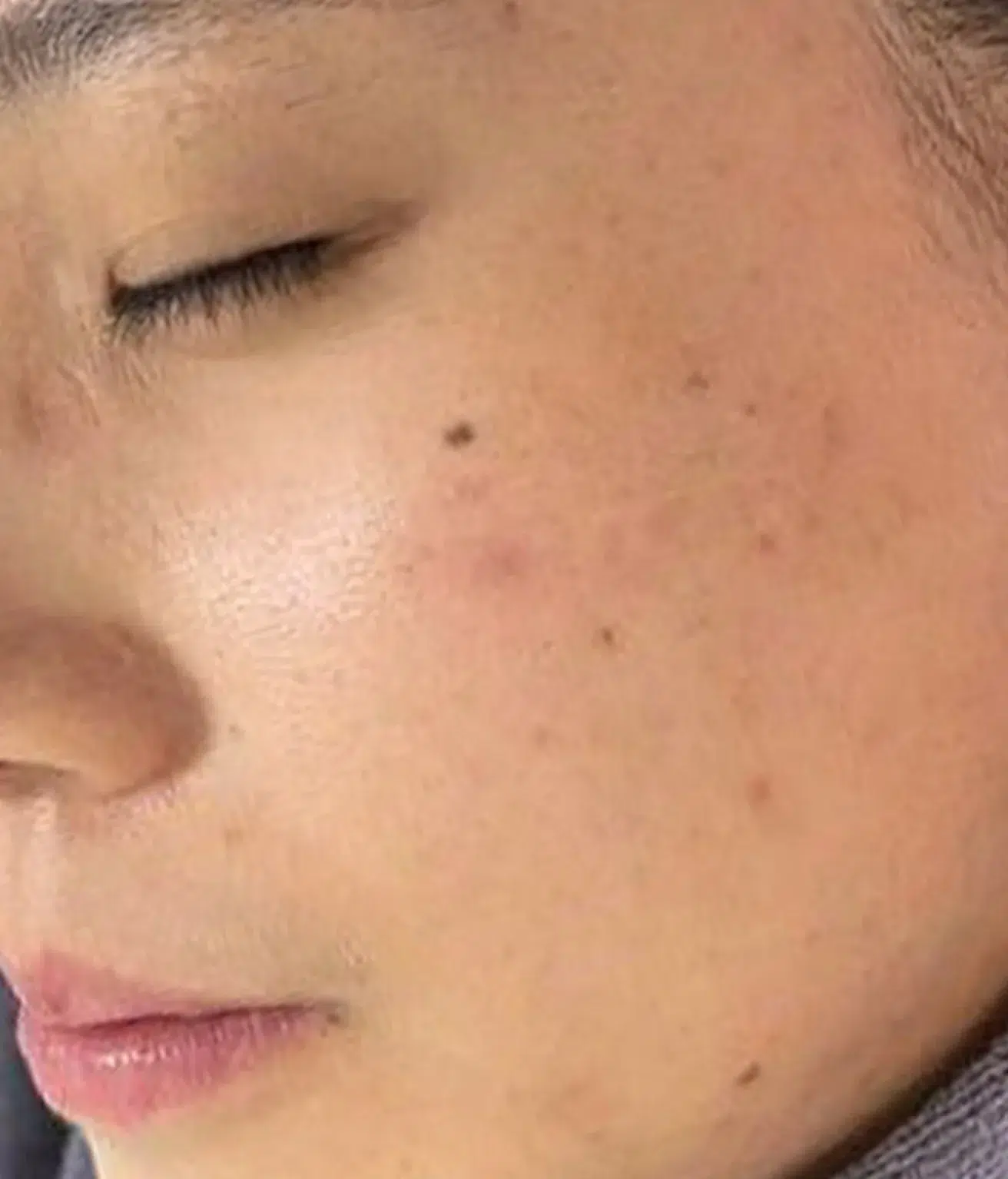 水光针 27 痤疮/粉刺/痘痘 治疗后 · 案例 04 · ID 医美