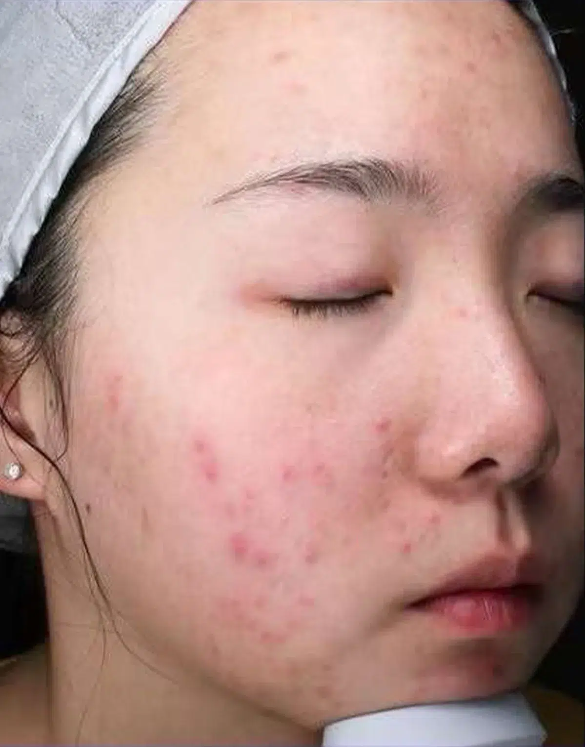痤疮/粉刺/痘痘 治疗前 · 案例 02 · ID 医美