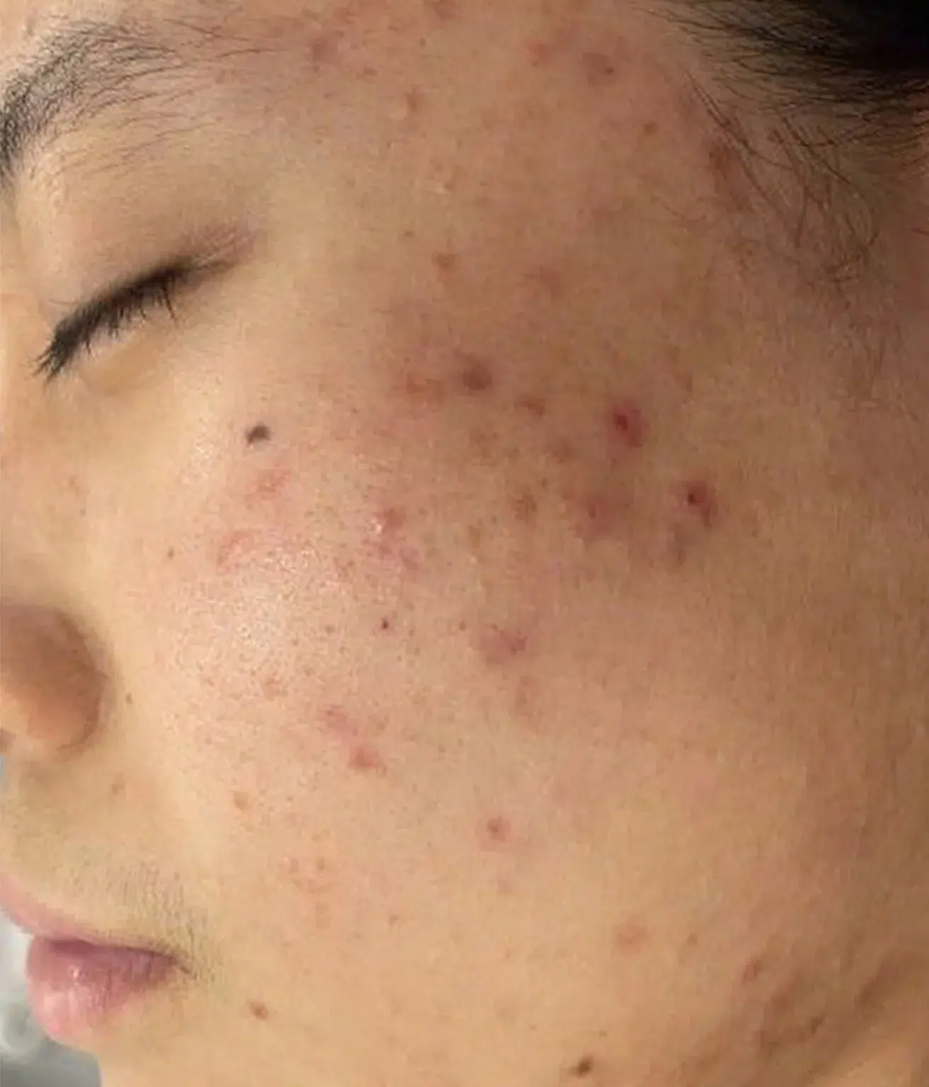 水光针 25 痤疮/粉刺/痘痘 治疗前 · 案例 04 · ID 医美