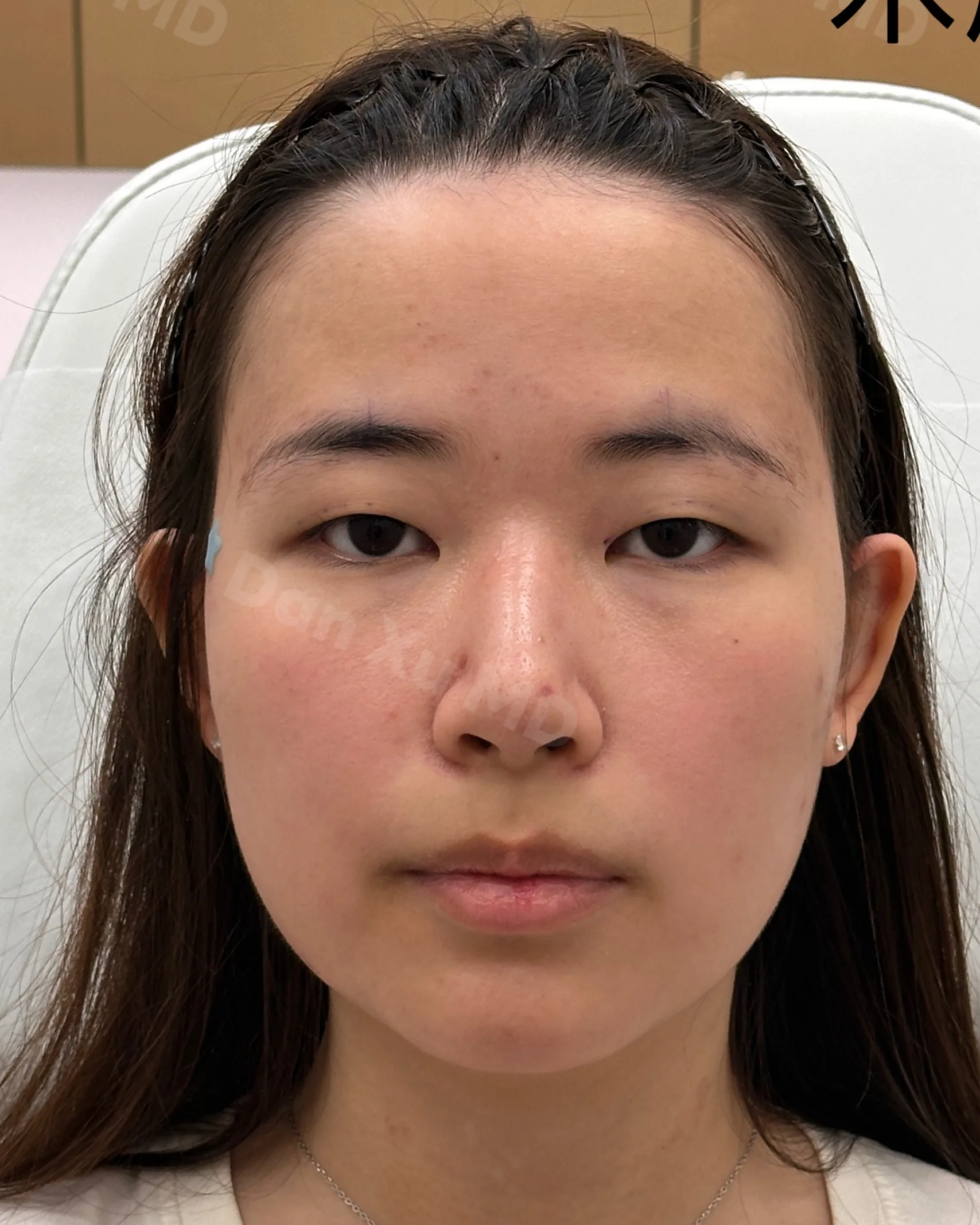 泪沟治疗前效果对比图 · ID Cosmetic Clinic 多伦多·万锦 · Dr. Dan Xu 医生主导 · 案例06