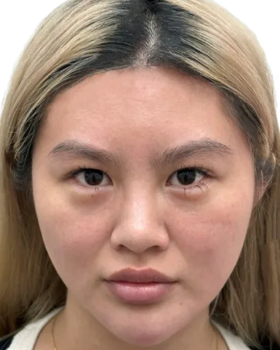 樱花镭射 19 敏感泛红 治疗后 · 案例 02 · ID 医美