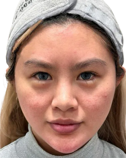 樱花镭射 17 敏感泛红 治疗前 · 案例 02 · ID 医美