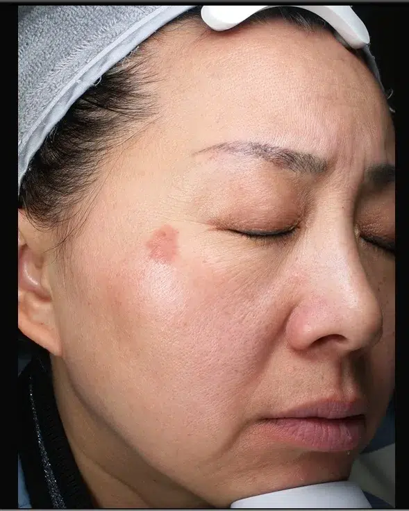 老年斑 / 晒斑治疗前效果对比图 · ID Cosmetic Clinic 多伦多·万锦 · Dr. Dan Xu 医生主导 · 案例04