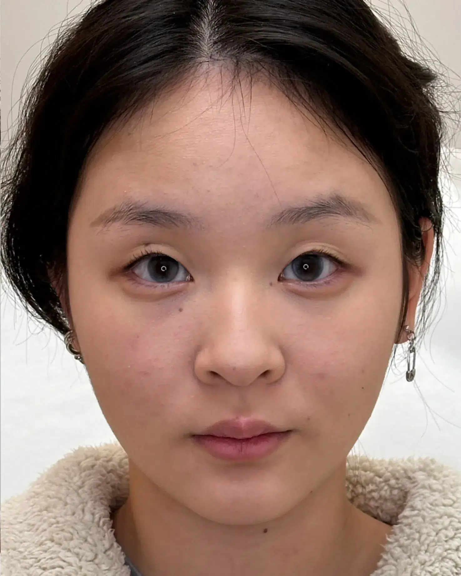 黑眼圈 · 眼袋 治疗后 · ID 医美