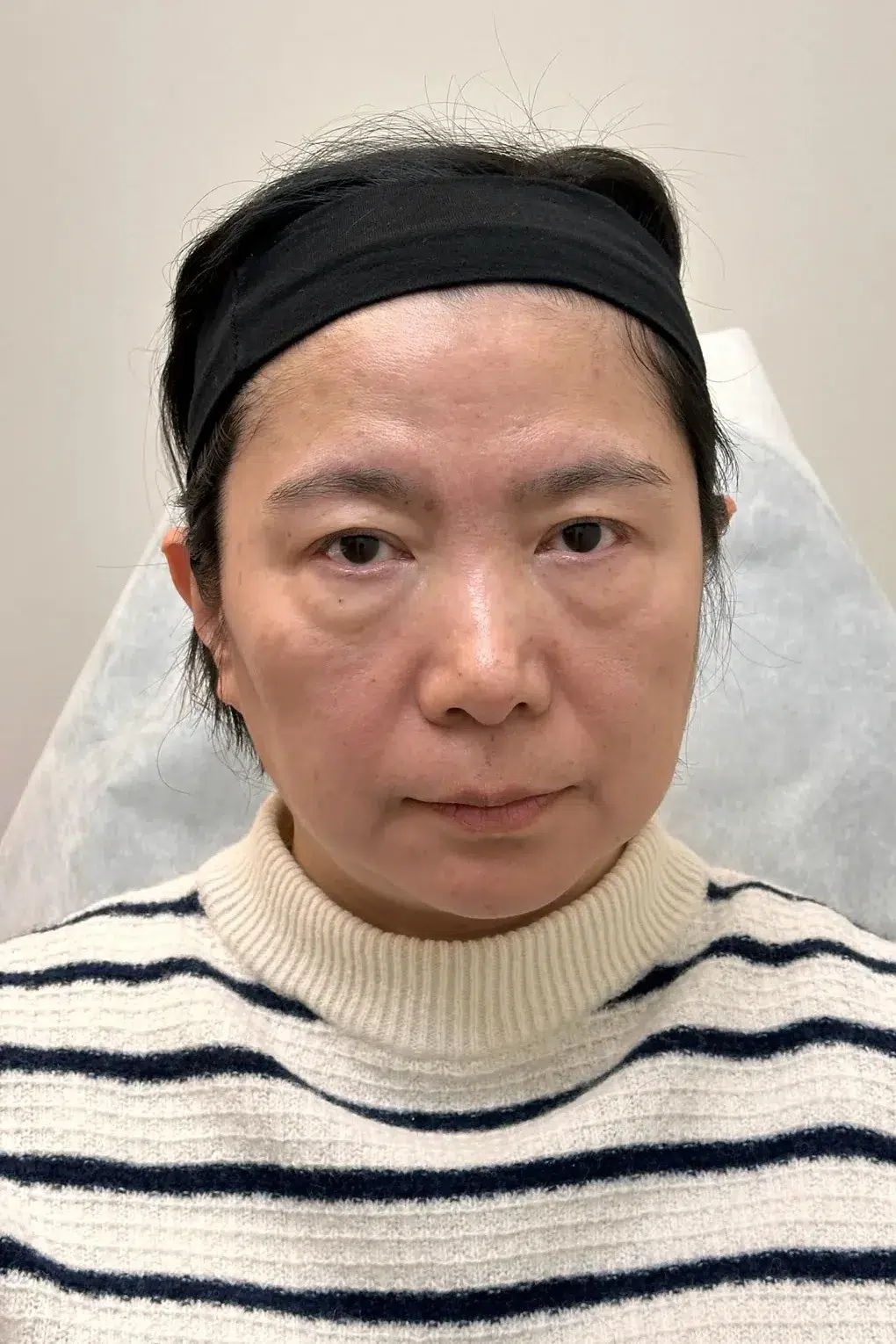 眼袋与黑眼圈治疗前效果对比图 · ID Cosmetic Clinic 多伦多·万锦 · Dr. Dan Xu 医生主导 · 案例01