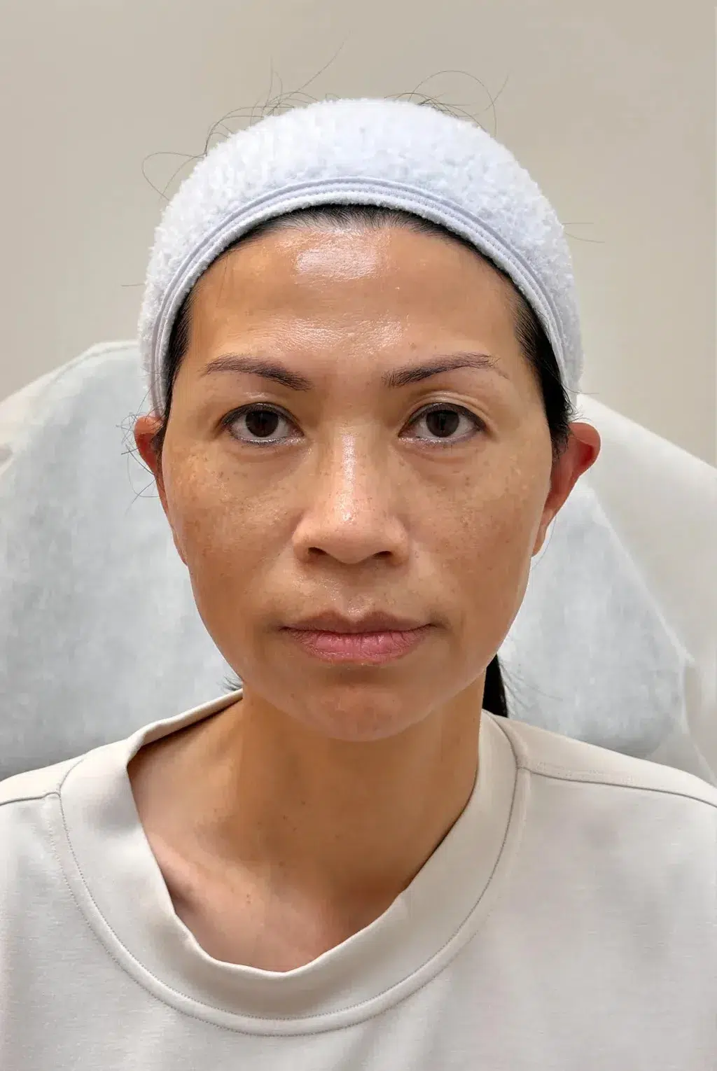 肤色不均治疗前效果对比图 · ID Cosmetic Clinic 多伦多·万锦 · Dr. Dan Xu 医生主导 · 案例03