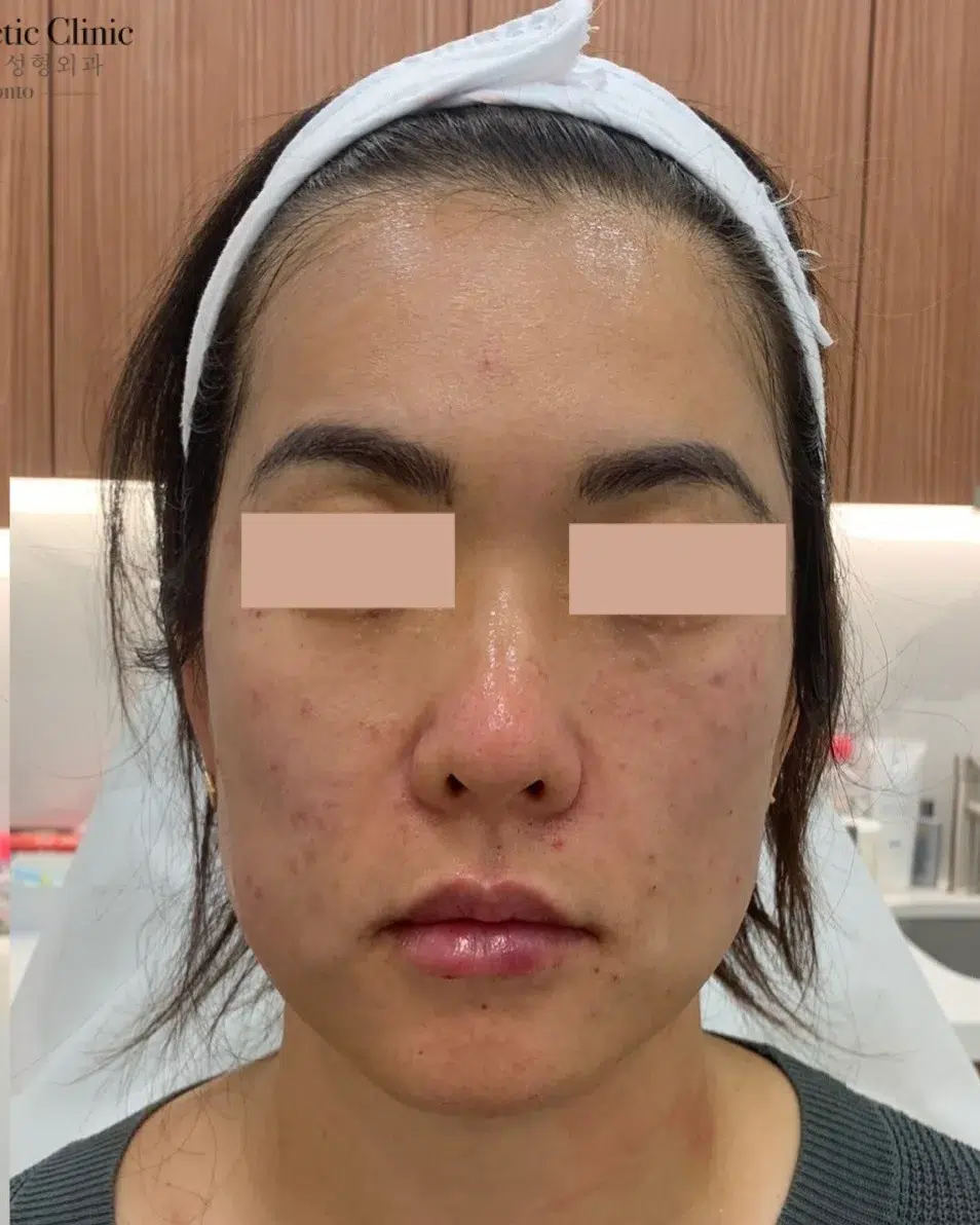 Filler Lip Augmentation 11 面部松垂/嘴边肉 治疗后 · 案例 01 · ID 医美