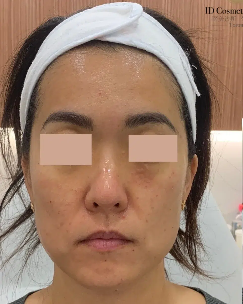 Filler Lip Augmentation 9 面部松垂/嘴边肉 治疗前 · 案例 01 · ID 医美