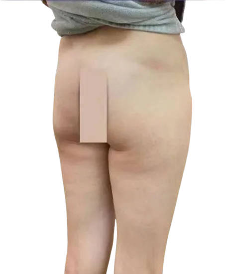 非手术丰臀改善臀部扁平治疗前对比 · Sculptra胶原增容 · ID Cosmetic Clinic 多伦多·万锦 · 案例01