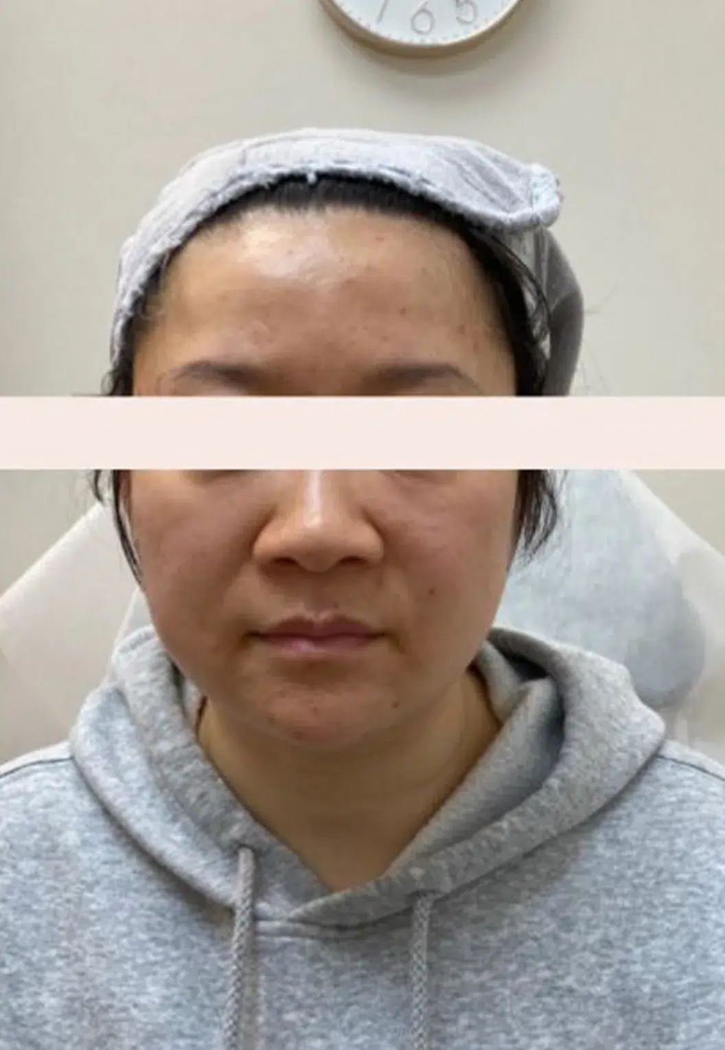 川字纹 · 眉间纹 治疗前 · ID 医美