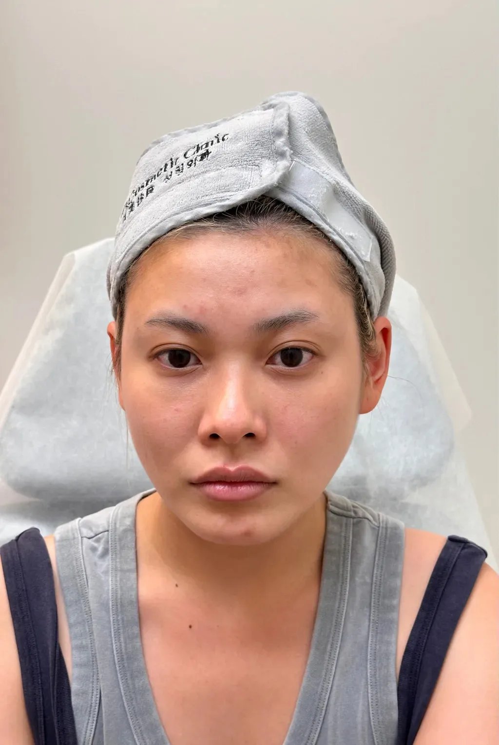太阳穴凹陷治疗前效果对比图 · ID Cosmetic Clinic 多伦多·万锦 · Dr. Dan Xu 医生主导 · 案例02