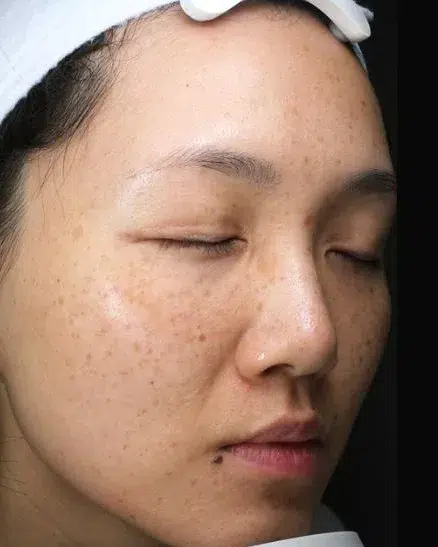 肤色暗沉 · 美白 治疗前 · ID 医美