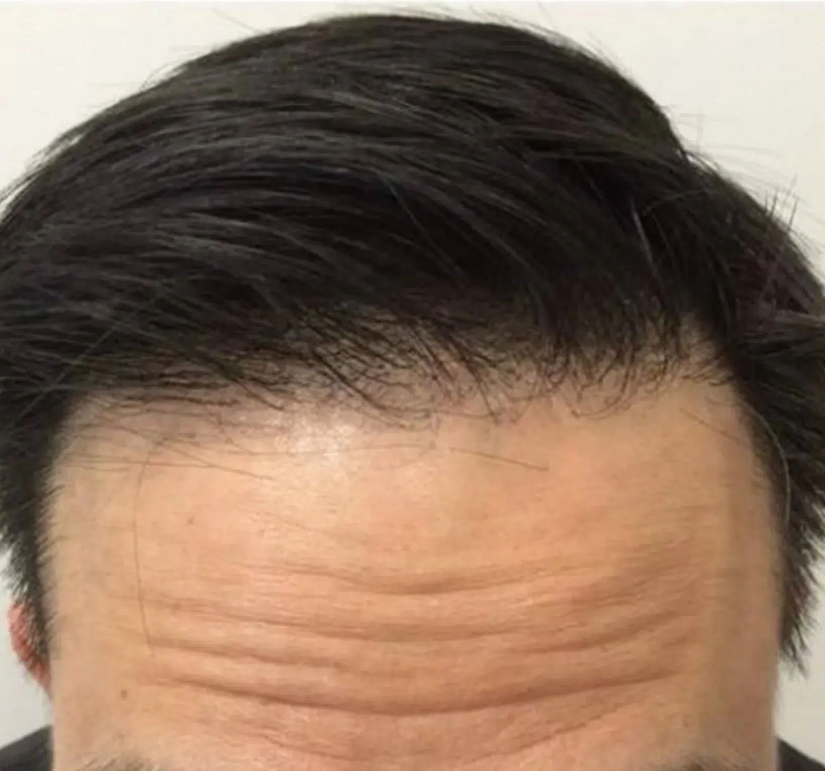 脱发 · 生发 治疗后 · ID 医美