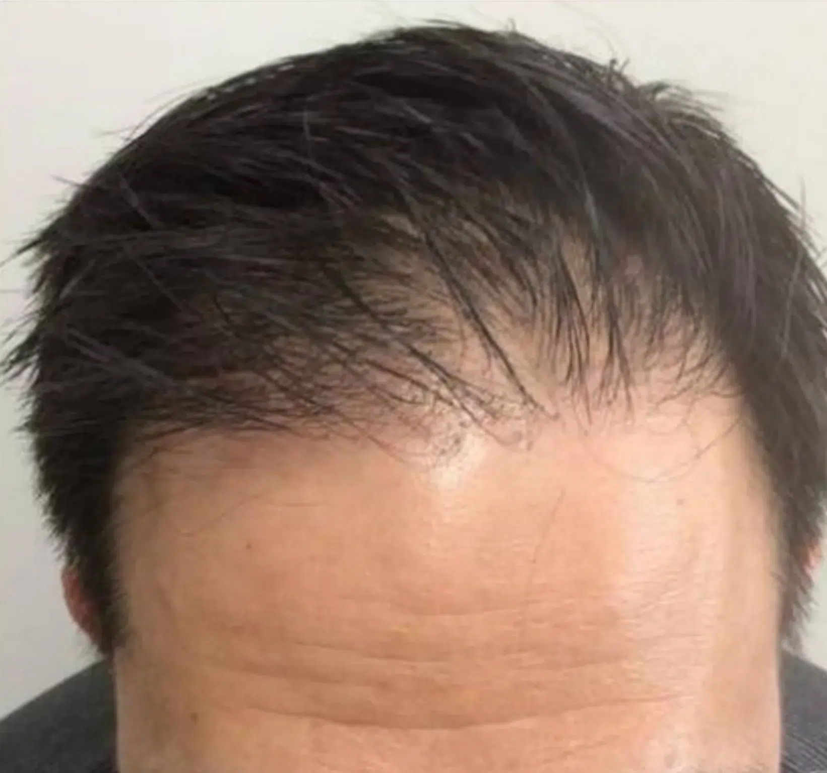 脱发 · 生发 治疗前 · ID 医美
