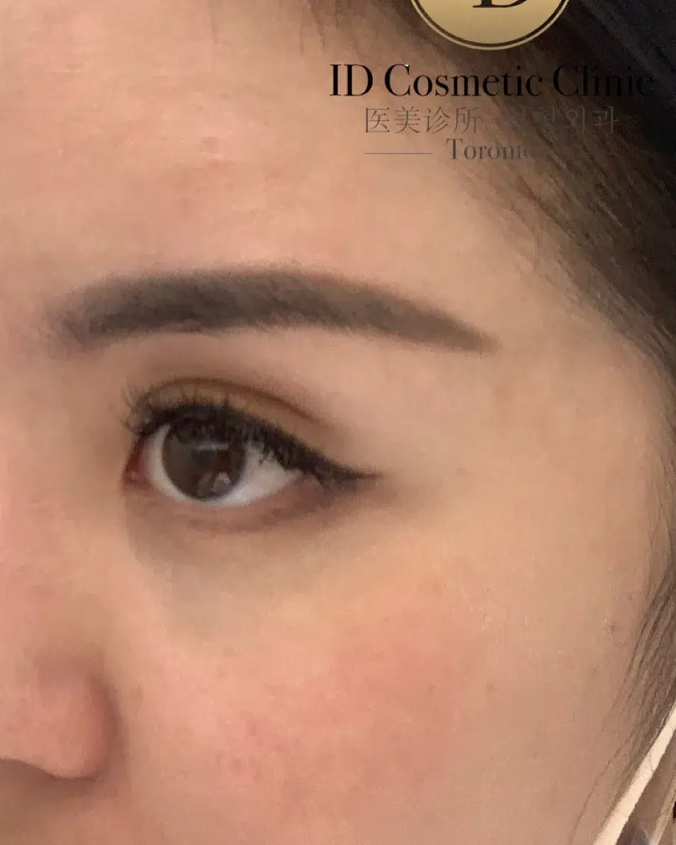铂金蜂巢皮秒PicoSure Pro® 279 铂金蜂巢皮秒PicoSure Pro®治疗褐青斑治疗后对比 · 铂金蜂巢皮秒PicoSure Pro®在多模态方案中的应用 · Dr. Dan Xu 多伦多·万锦 · 案例01