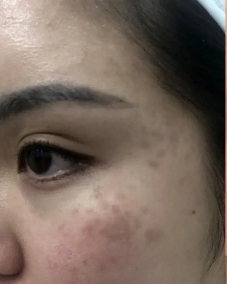 铂金蜂巢皮秒PicoSure Pro® 277 铂金蜂巢皮秒PicoSure Pro®治疗褐青斑治疗前对比 · 铂金蜂巢皮秒PicoSure Pro®在多模态方案中的应用 · Dr. Dan Xu 多伦多·万锦 · 案例01