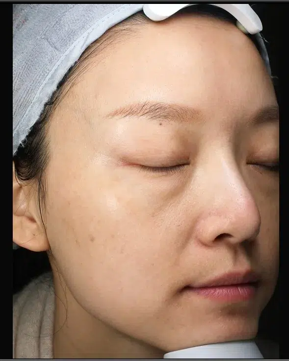 色斑·色素沉着综合 99 色素沉着治疗后效果对比图 · ID Cosmetic Clinic 多伦多·万锦 · Dr. Dan Xu 医生主导 · 案例09
