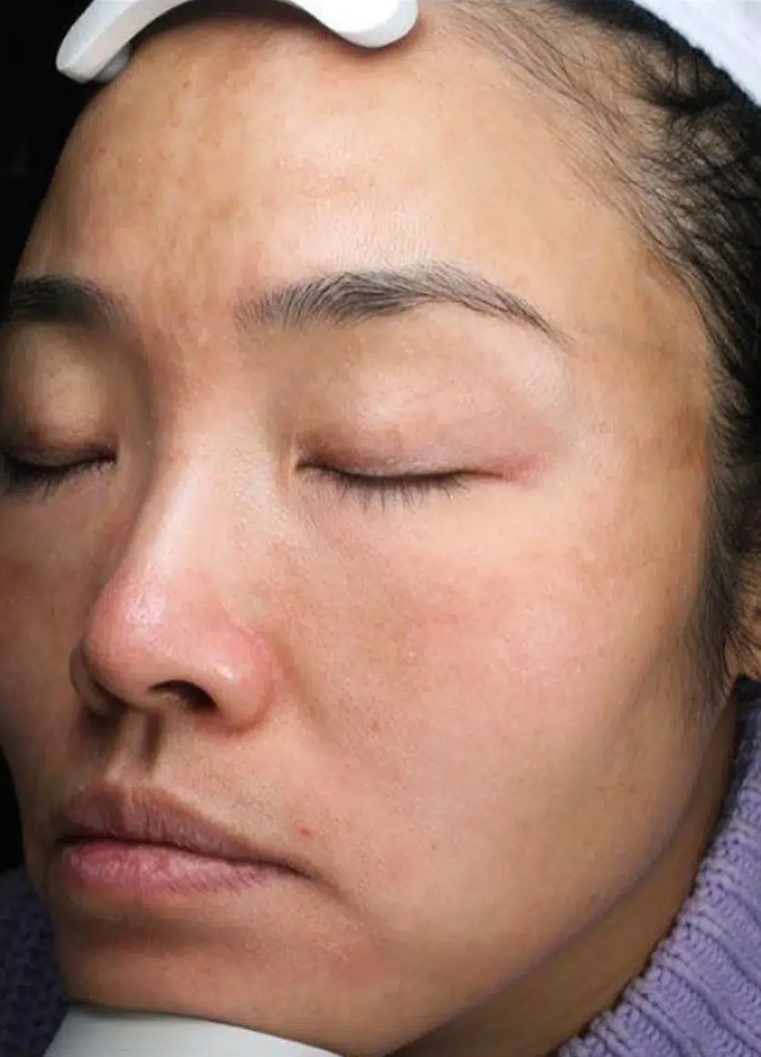 色斑·色素沉着综合 107 色素沉着治疗后效果对比图 · ID Cosmetic Clinic 多伦多·万锦 · Dr. Dan Xu 医生主导 · 案例11