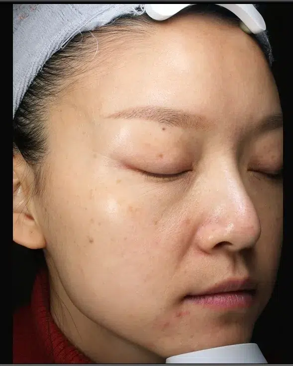 色斑·色素沉着综合 97 色素沉着治疗前效果对比图 · ID Cosmetic Clinic 多伦多·万锦 · Dr. Dan Xu 医生主导 · 案例09