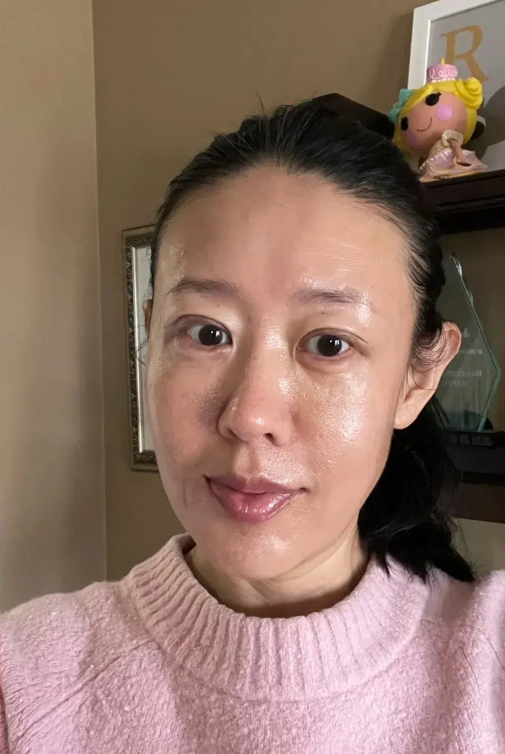 苹果肌流失 · 面颊凹陷 治疗后 · ID 医美