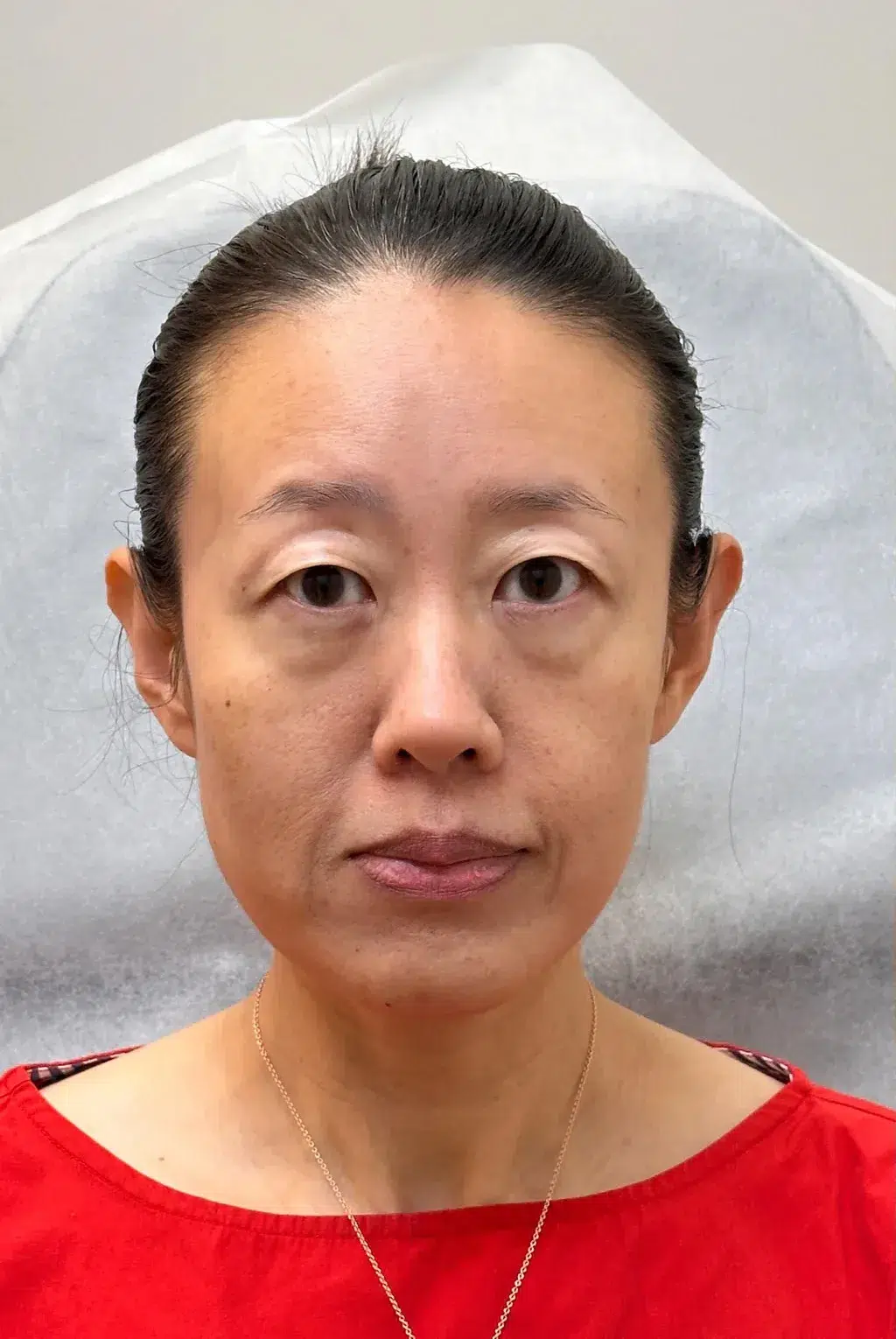 苹果肌流失 · 面颊凹陷 治疗前 · ID 医美
