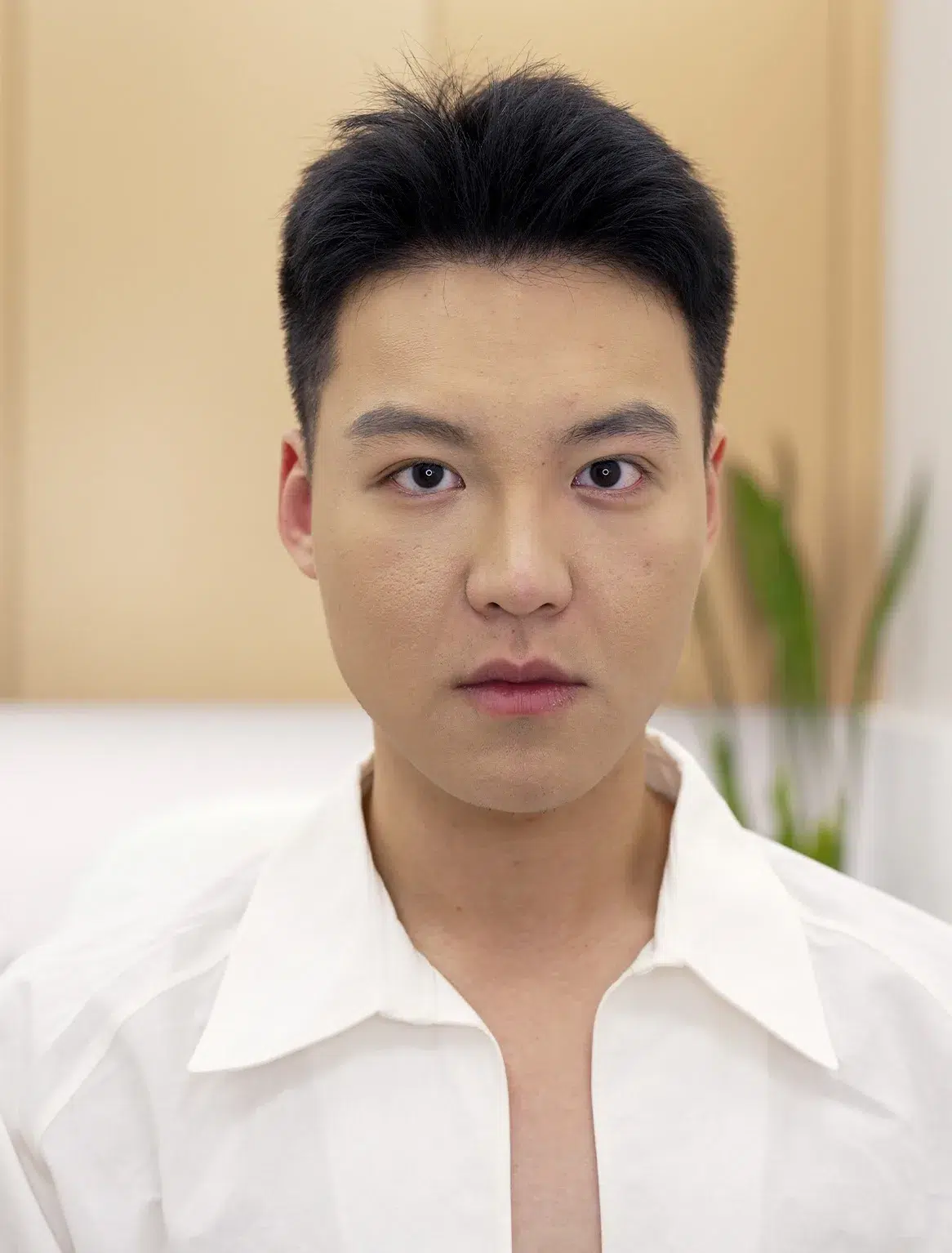 Scars 7 疤痕 治疗后 · 案例 02 · ID 医美