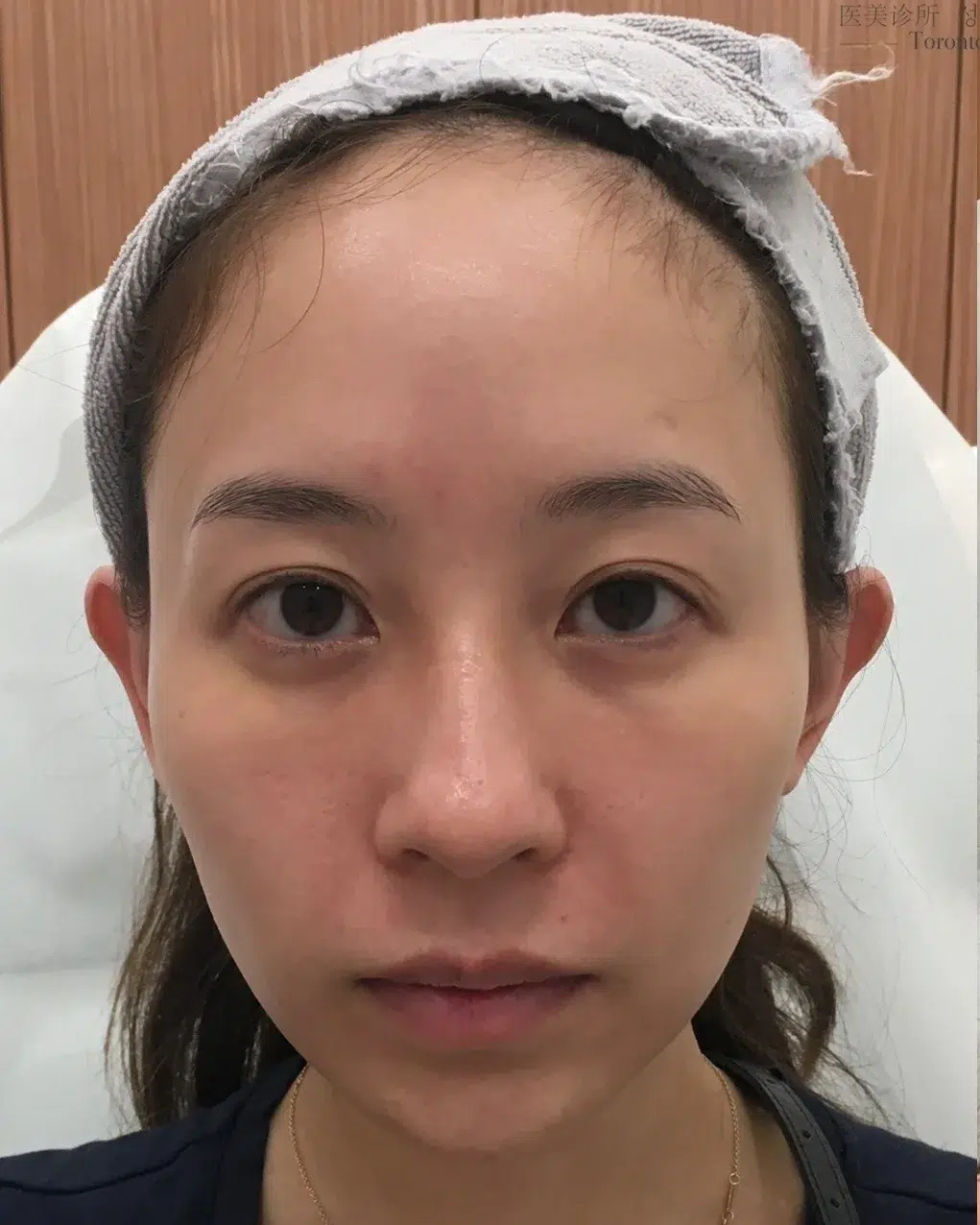 下巴后缩 治疗前 · 案例 08 · ID 医美