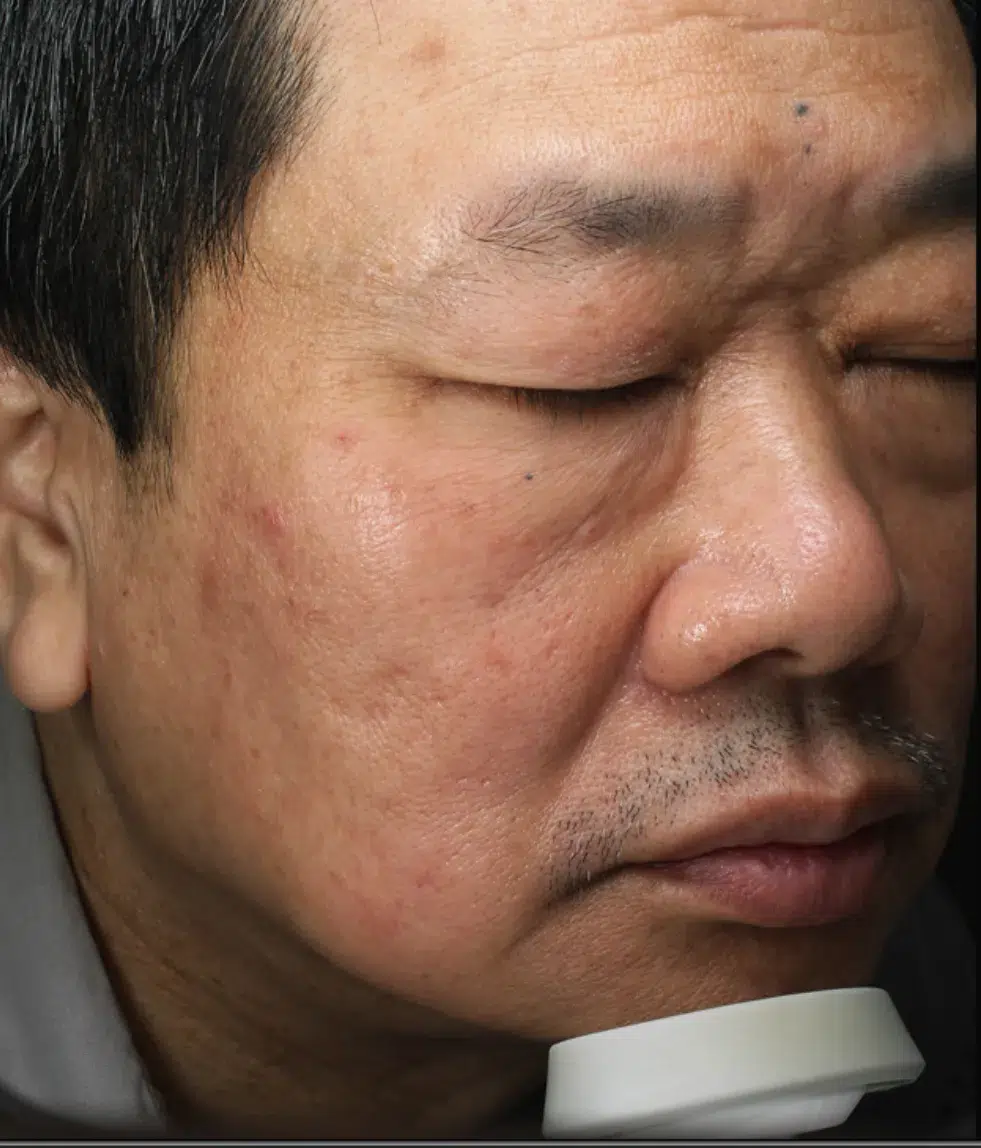 炎症后色素沉着(PIH) 3 炎症后色素沉着 治疗后 · 案例 01 · ID 医美