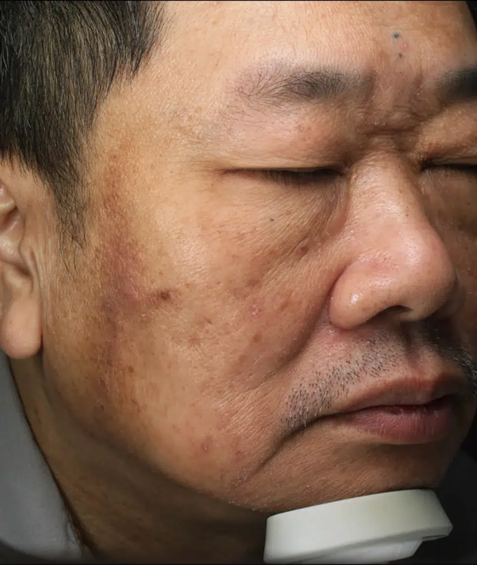炎症后色素沉着 治疗前 · 案例 01 · ID 医美