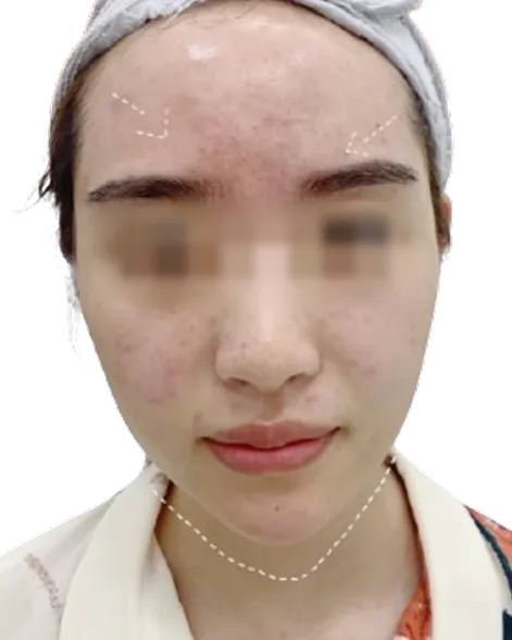 下巴后缩 · 短下巴 治疗后 · ID 医美