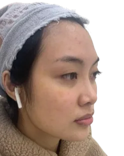 馒化脸 治疗后 · ID 医美