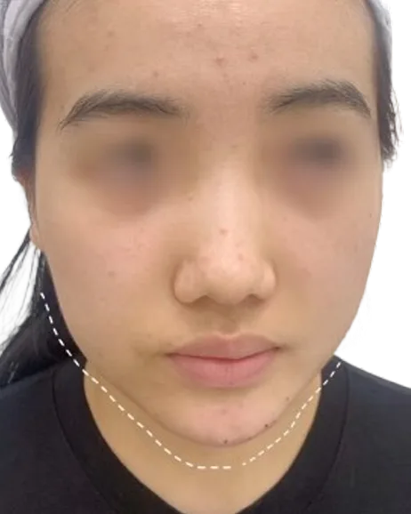双下巴 治疗后 · ID 医美