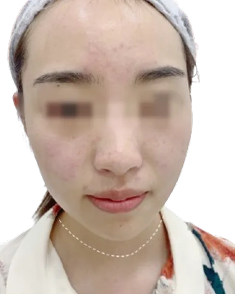 下巴后缩 · 短下巴 治疗前 · ID 医美