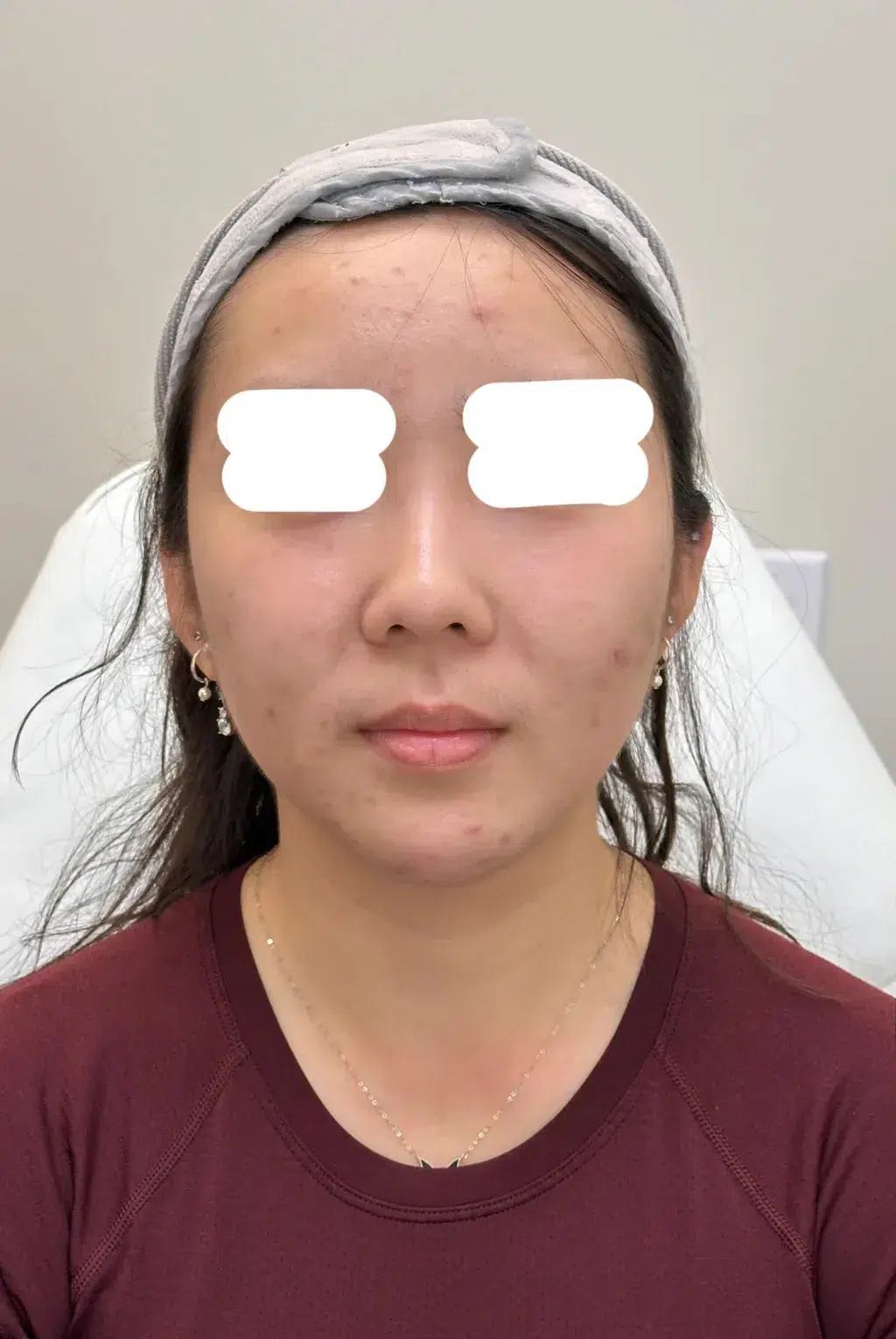 塌鼻/低鼻梁治疗前效果对比图 · ID Cosmetic Clinic 多伦多·万锦 · Dr. Dan Xu 医生主导 · 案例01