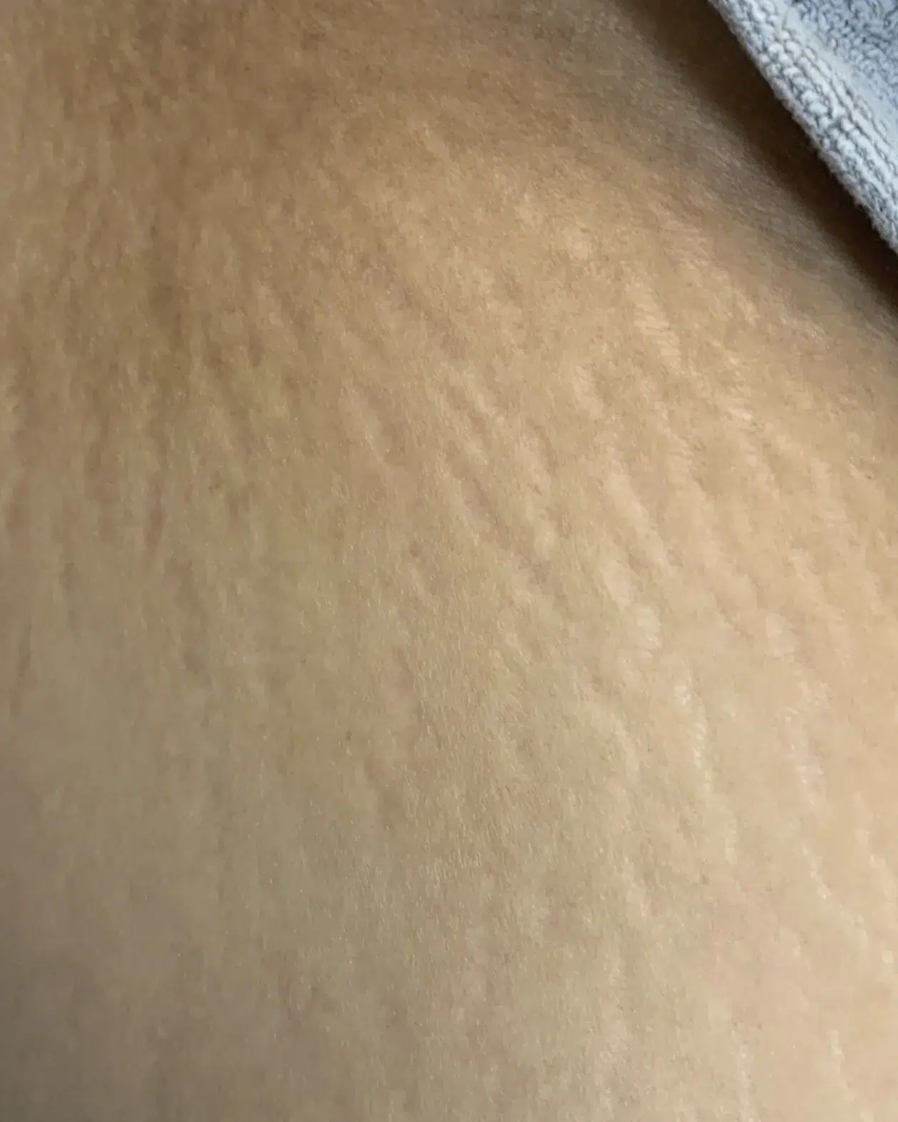 妊娠纹 · 生长纹 治疗前 · ID 医美