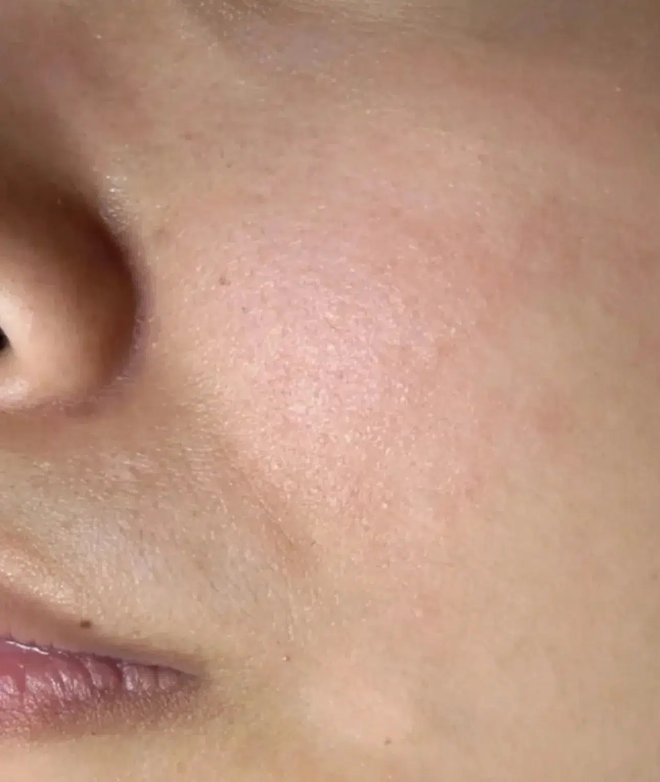 肤色不均治疗前效果对比图 · ID Cosmetic Clinic 多伦多·万锦 · Dr. Dan Xu 医生主导 · 案例04