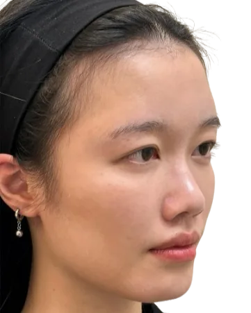 面颊凹陷·苹果肌流失治疗前效果对比图 · ID Cosmetic Clinic 多伦多·万锦 · Dr. Dan Xu 医生主导 · 案例05