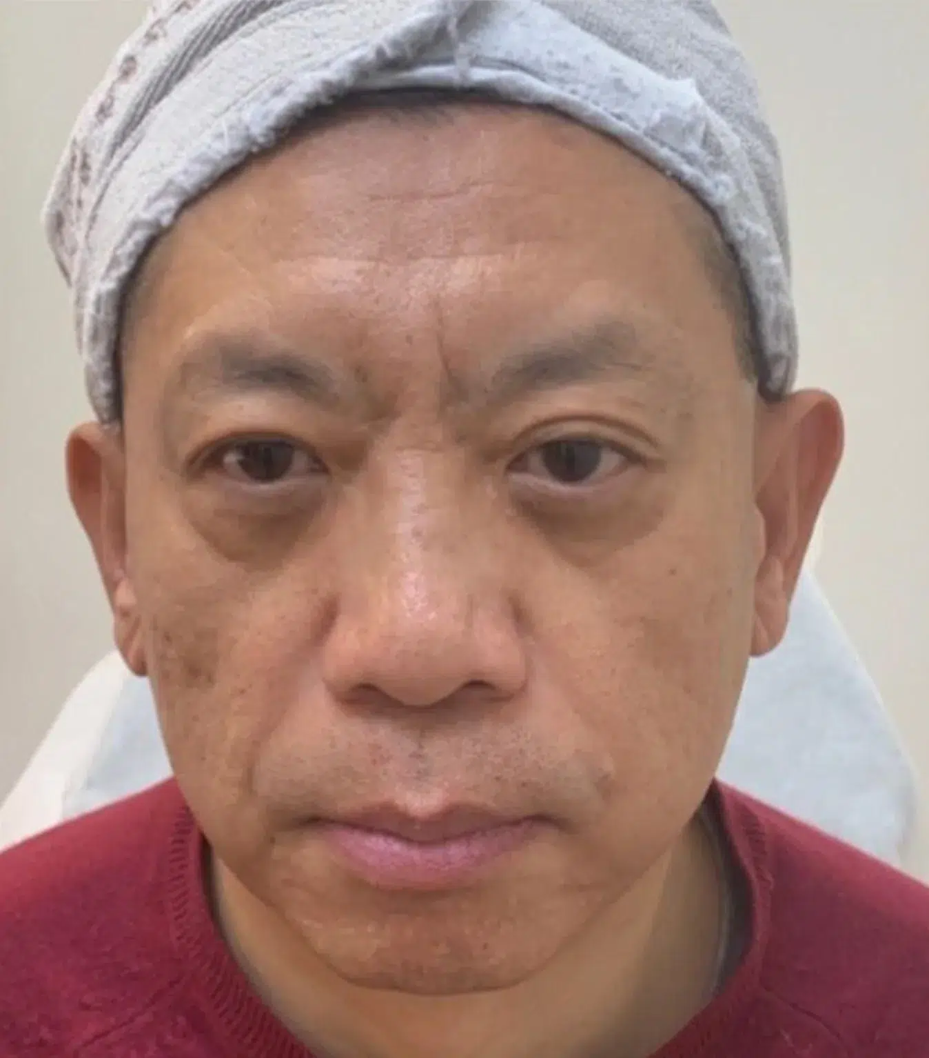 颈纹综合 17 颈纹综合 治疗前 · 案例 06 · ID 医美