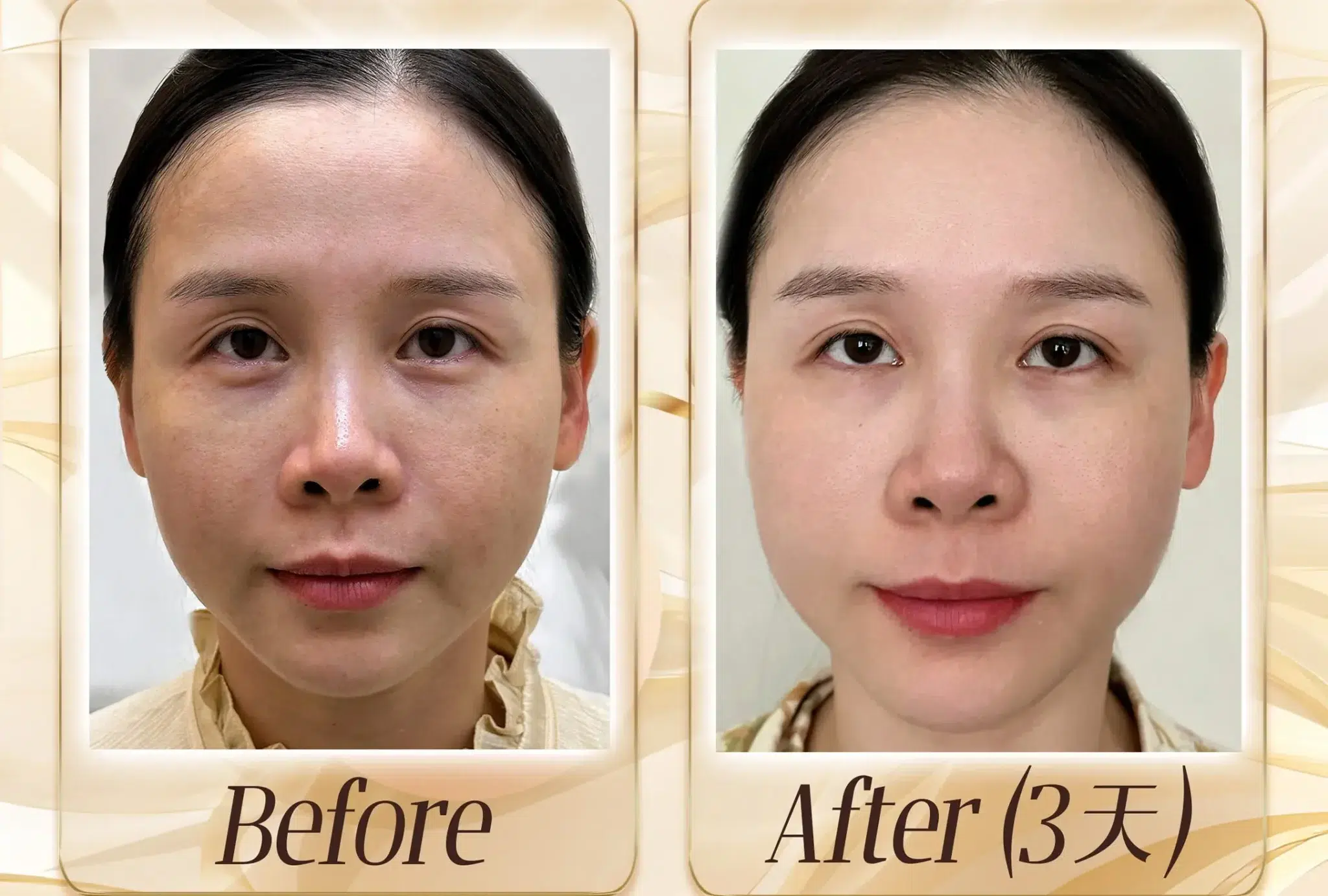 rejuran toronto 丽珠兰 rejuran healer scaled