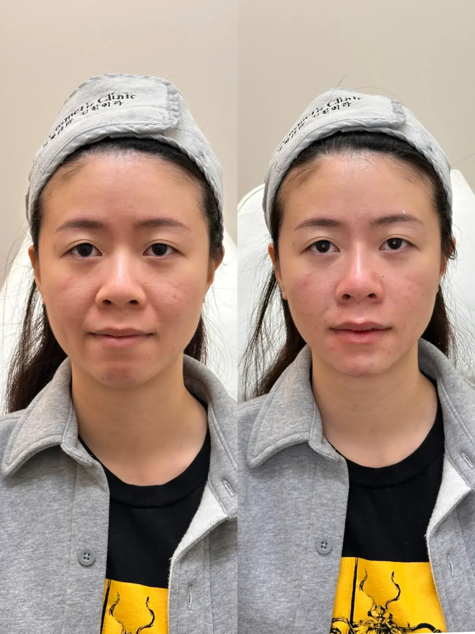 法令纹 scaled 1 scaled