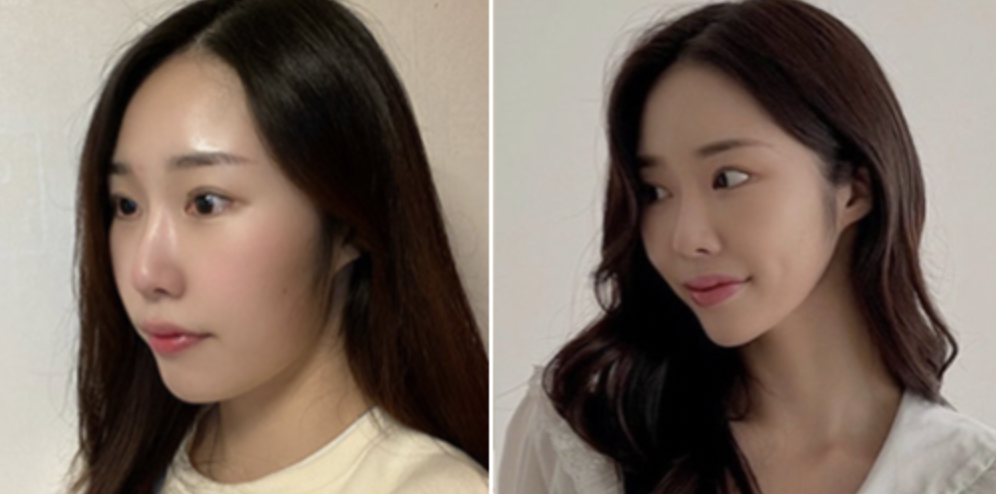 韩国提升项目｜【Titanium钛提升】提亮提拉瘦脸三效合一，激光无痛提升！