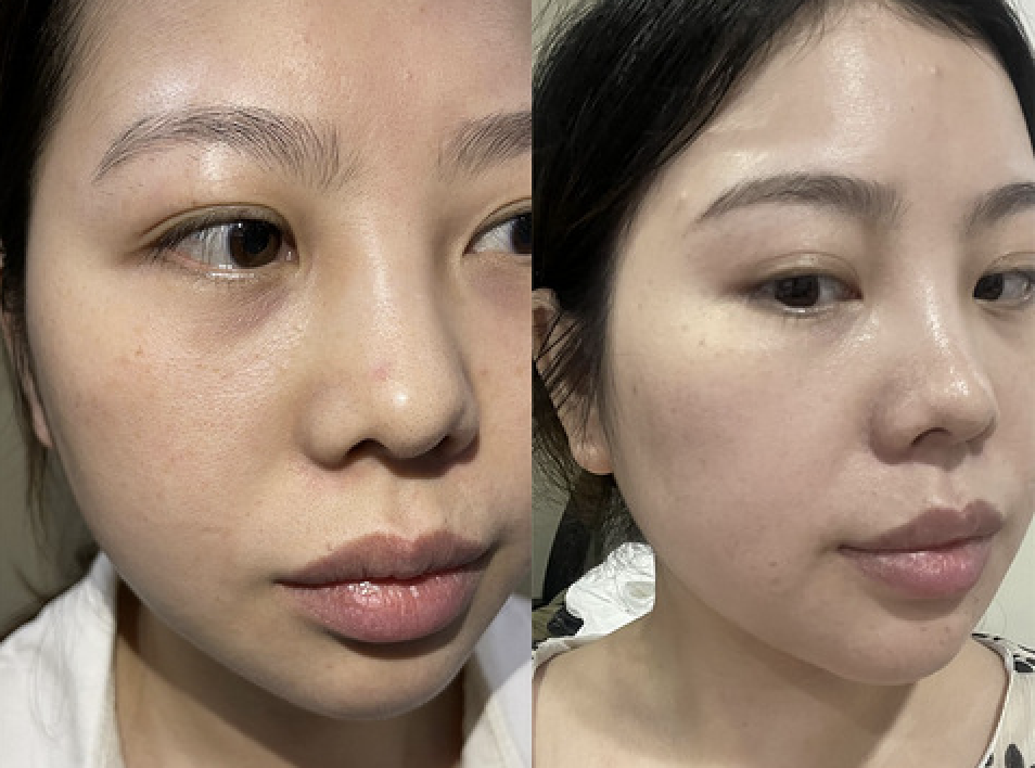 黄金微针前后对比